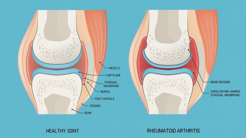 Rheumatoid Arthritis Expert in Ahmedabad